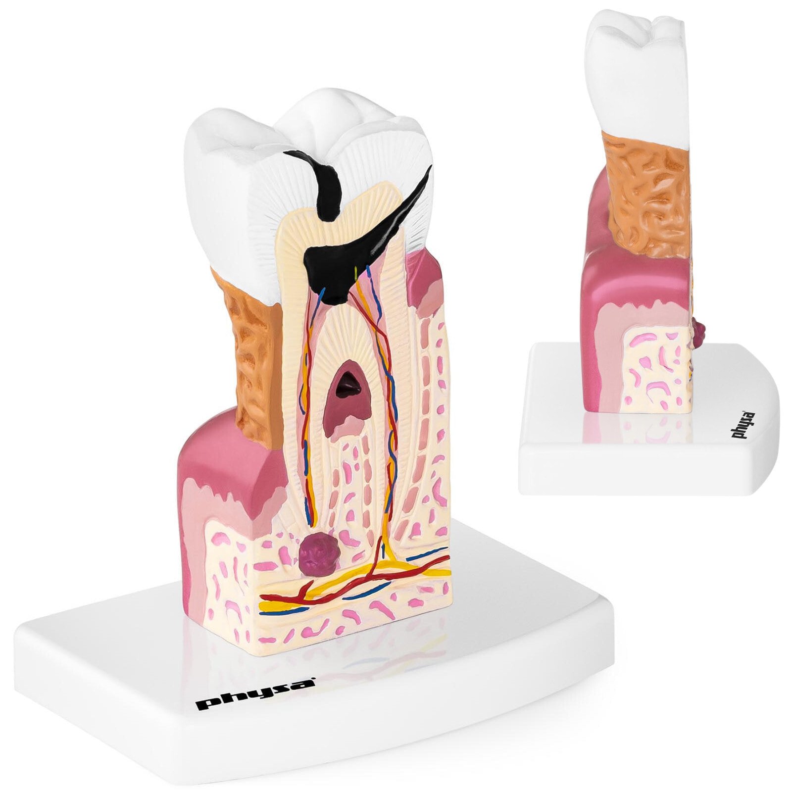 Anatomical model of a sick human tooth on a scale of 6: 1