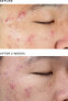 Deep Relief Blemish Treatment