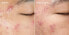 Deep Relief Blemish Treatment